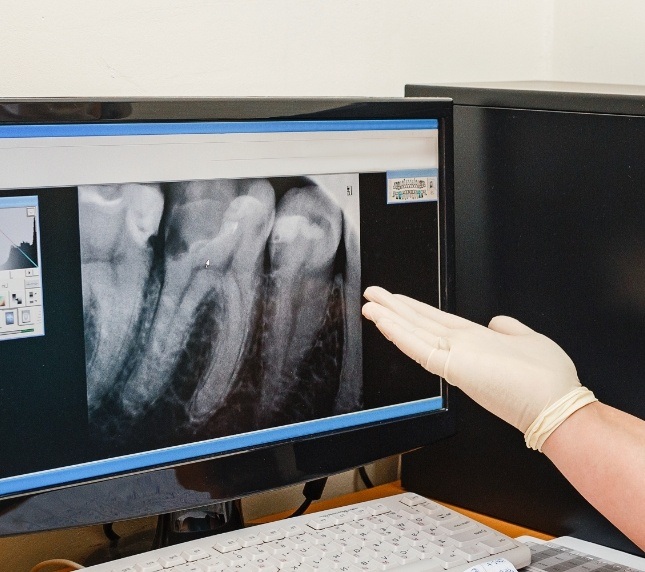 Hand gesturing toward dental x ray on monitor