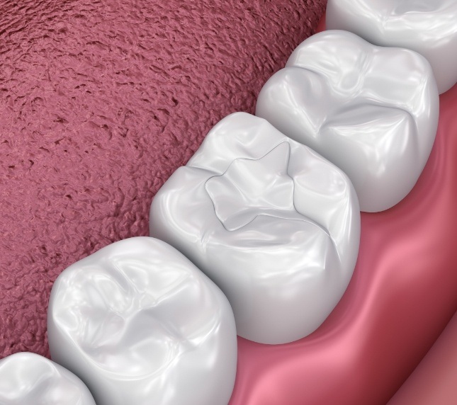 Illustration of dental sealant placed on tooth