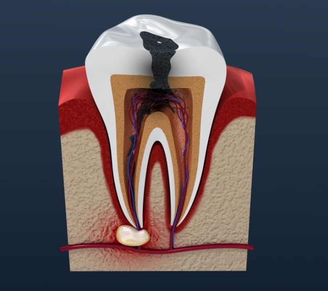 Illustration of a badly infected tooth