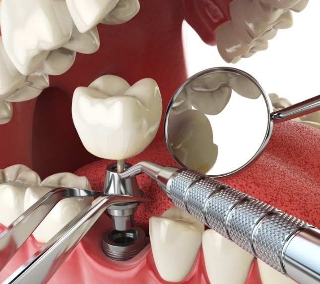 Dental implant and crown being placed in lower jaw