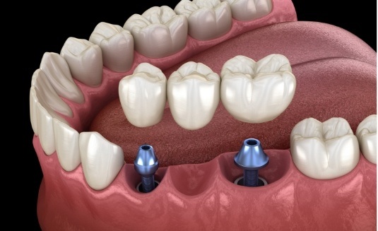 Dental bridge being attached to two dental implants
