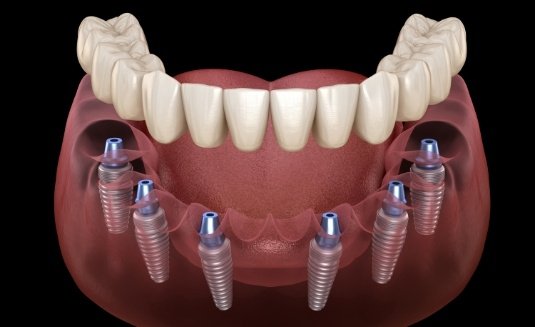 Dentures being attached to six dental implants