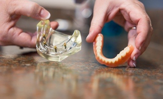 Holding dentures and model of dental implants