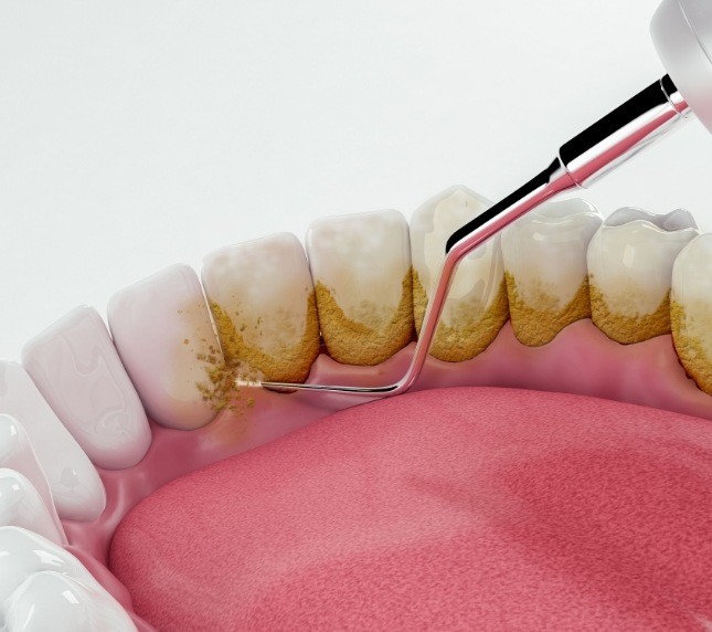 Illustration of scaling and root planing for gum disease treatment in Owings Mills