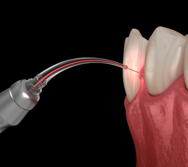 Gums being treated with a dental laser