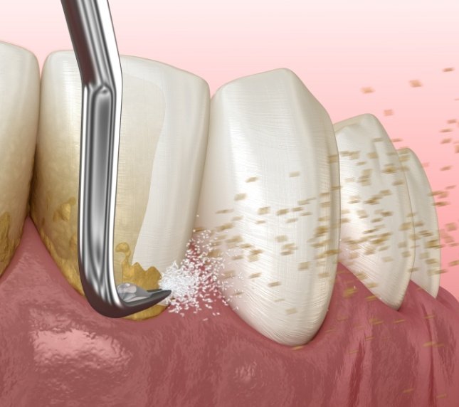 Plaque and tartar being removed from the teeth