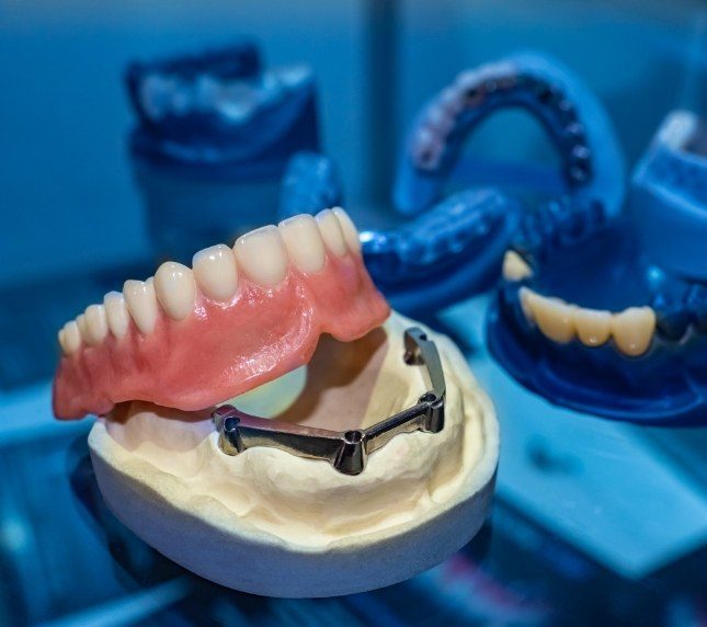 Dental implants and dentures on model of mouth