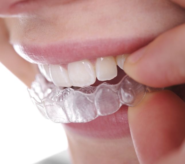 Woman putting in an aligner for Invisalign in Owings Mills