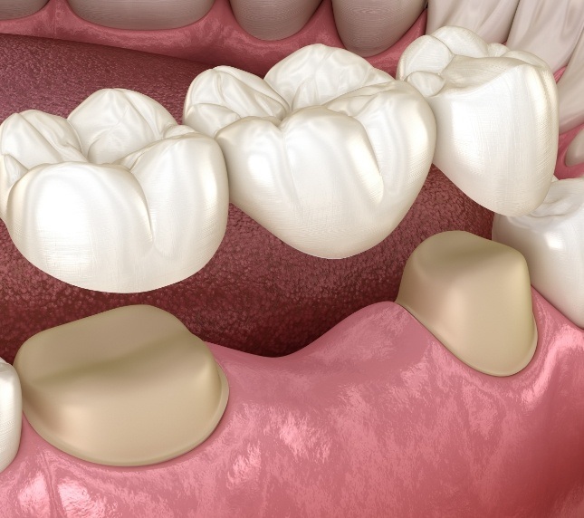 Illustration of dental bridge for replacing missing teeth in Owings Mills