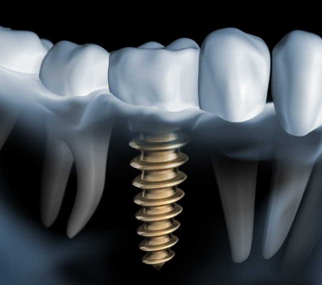 Illustration of dental implant in jaw