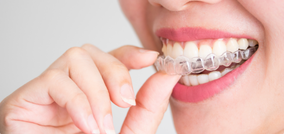 Putting in an Invisalign aligner