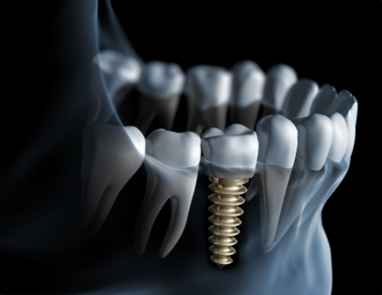 Illustration of dental implant in jaw