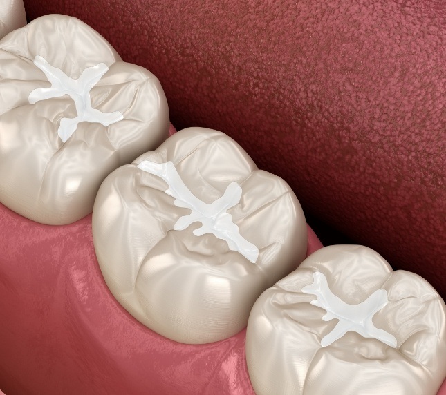 Illustration of tooth colored fillings