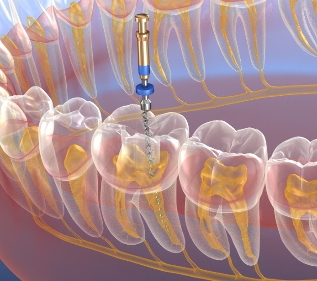 Illustration of root canal treatment in Owings Mills