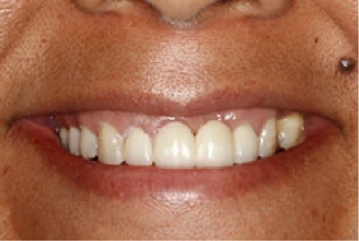 Closeup of teeth after treatment