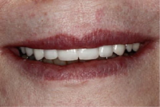 Close up of teeth after discoloration has been treated