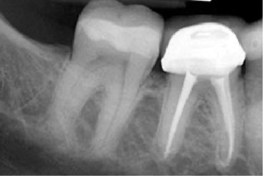 X ray of tooth after treatment