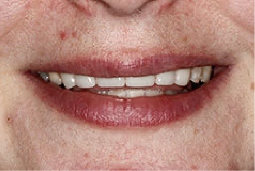 Close up of teeth with stains removed