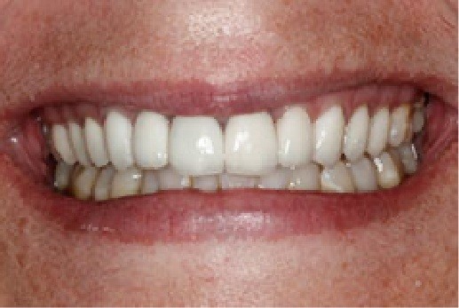 Close up of successfully treated teeth
