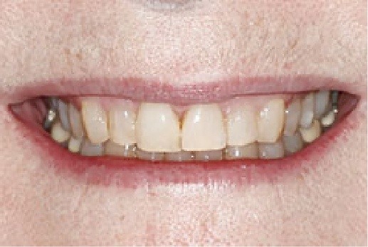 After treatment for misaligned teeth