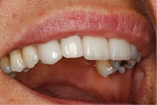 Close up of restored dental implant