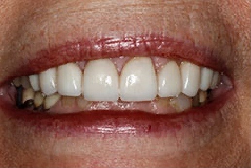 Close up of smile after teeth have been treated