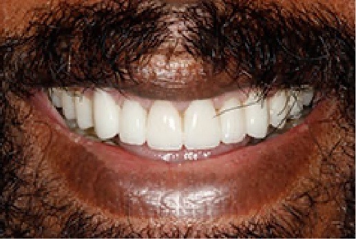 Close up of mustached mans teeth after treatment
