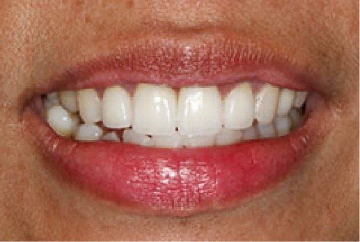 Close up of smile after dental treatment