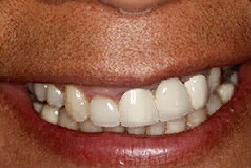 Closeup of teeth before treatment