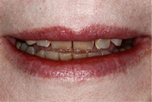 Close up of discolored teeth