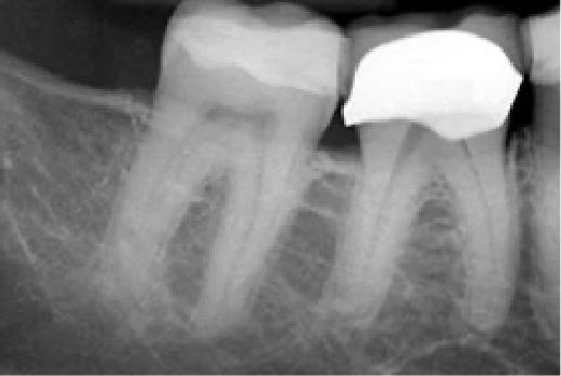 X ray of tooth before treatment