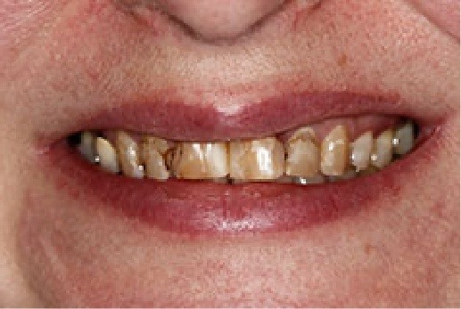 Close up of badly stained teeth