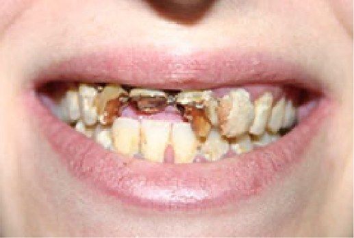 Close up of badly damaged teeth
