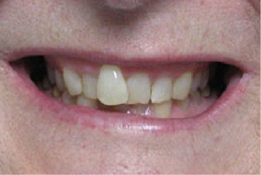 Misaligned teeth before treatment