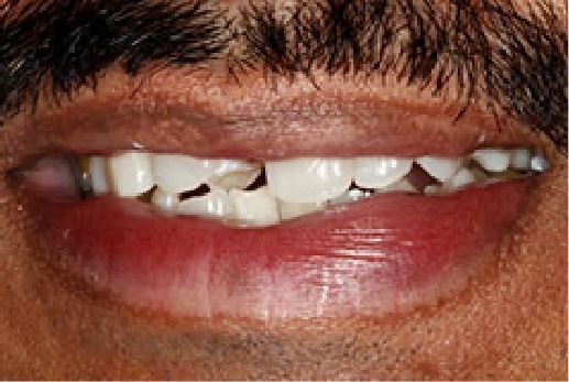 Close up of smile with broken teeth