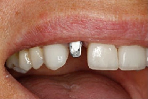 Close up of unrestored dental implant