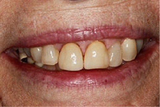 Close up of unhealthy teeth