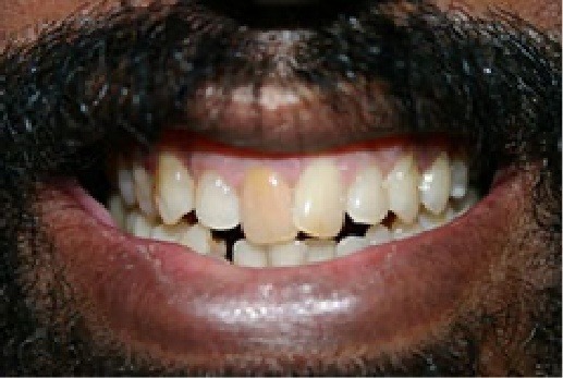 Close up of mustached mans teeth before treatment