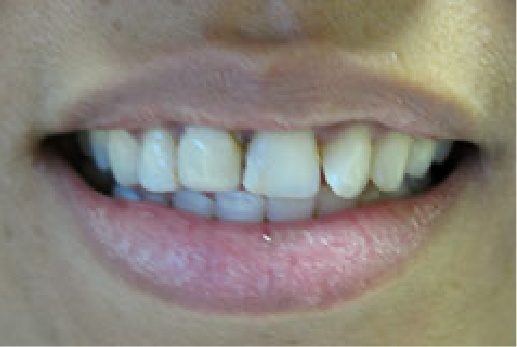 Close up of smile before dental treatment