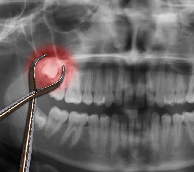 Forceps and x ray showing wisdom teeth in Owings Mills